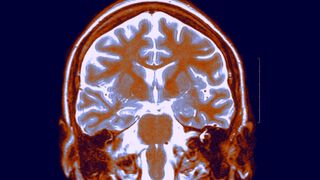 Brain MRI scan shows a view of the brain from the front