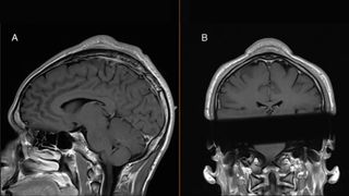 two mri images of a human head shown facing the back. A large lump can be seen on the skull from both sides